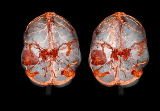 Метастазы рака и меланомы в головной мозг
